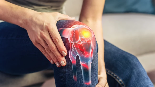arthritis