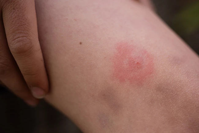 erythema migrans