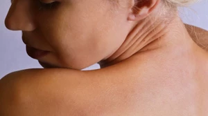 Καρκίνος του δέρματος: 4 βασικά πράγματα που πρέπει να γνωρίζεις - εικόνα 1