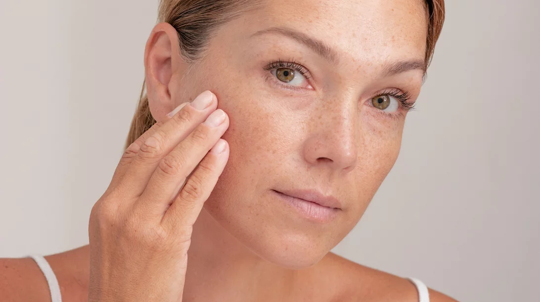 Καφέ κηλίδες και πανάδες | Το συστατικό που τις εξαφανίζει άμεσα κι αποτελεσματικά