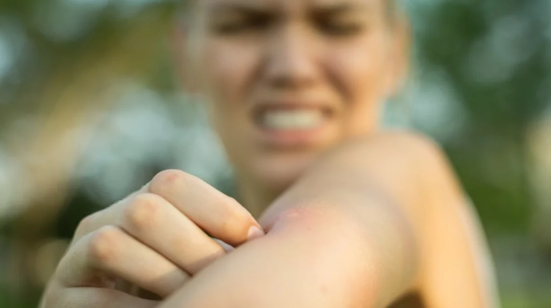 Τσιμπήματα κουνουπιών: Τι είναι αυτό που έλκει τα κουνούπια πάνω μας;