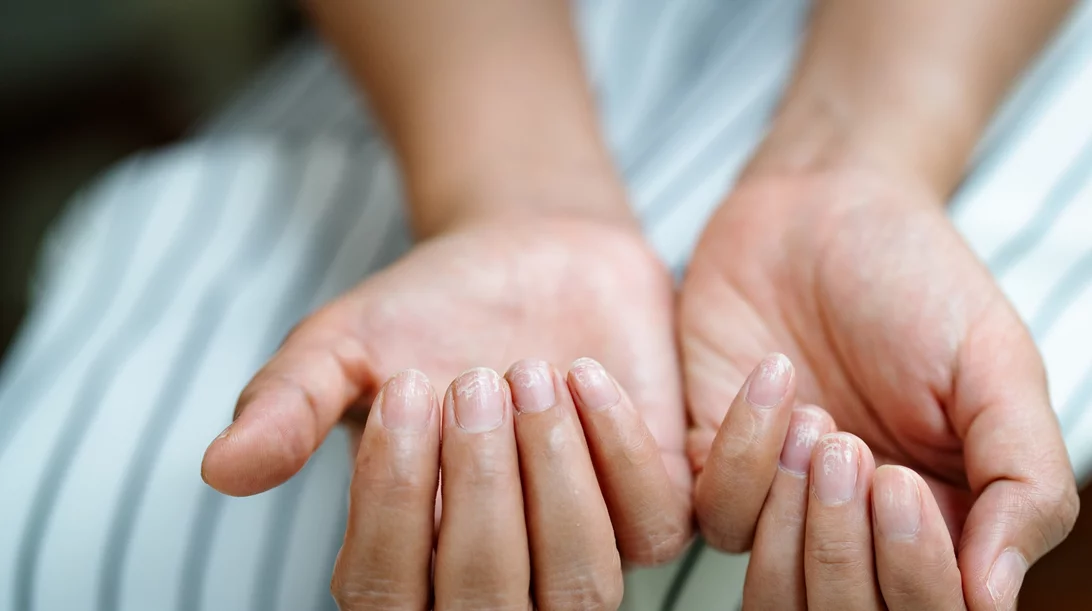 Αυτά τα σημάδια στα νύχια σου μπορεί να δείχνουν σοβαρό πρόβλημα - Μάθε ποια είναι!