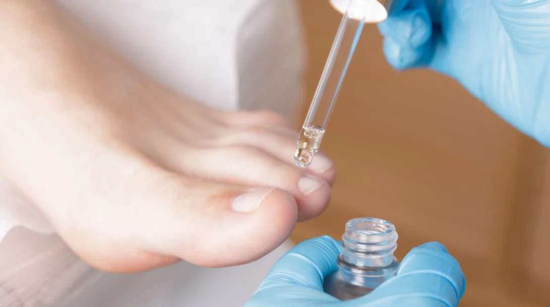 Είσφρυση όνυχος: Πώς το θεραπεύσεις αποτελεσματικά