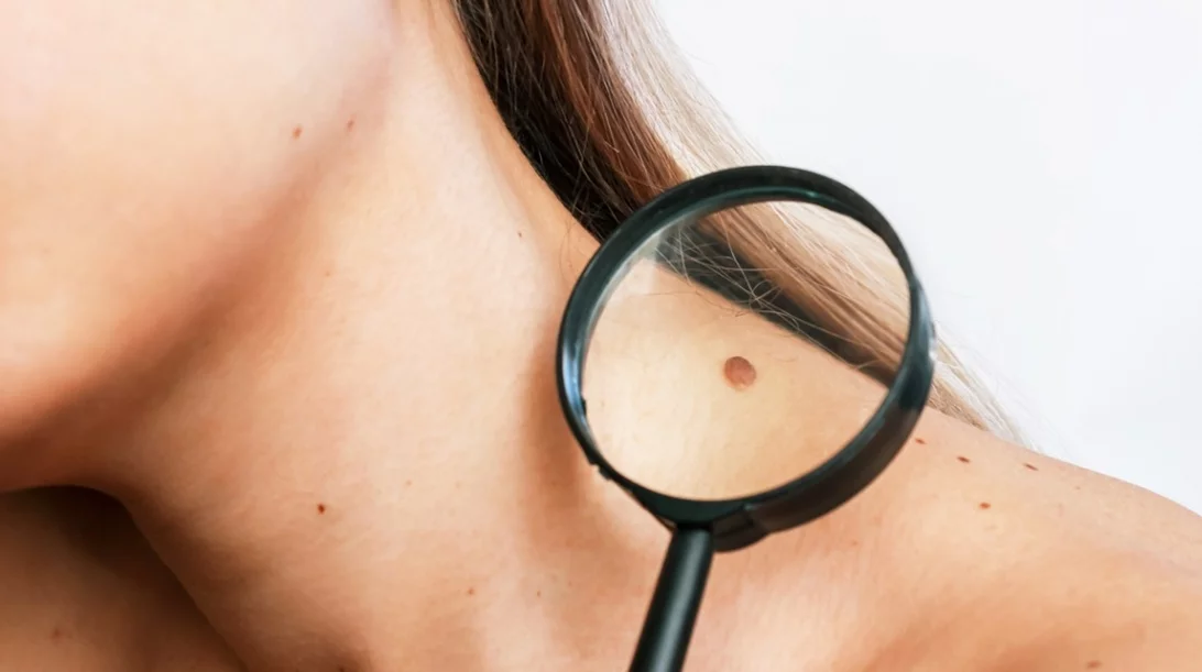 Εμβόλιο για τον καρκίνο του δέρματος: Τι περιμένουμε και πώς θα δρα
