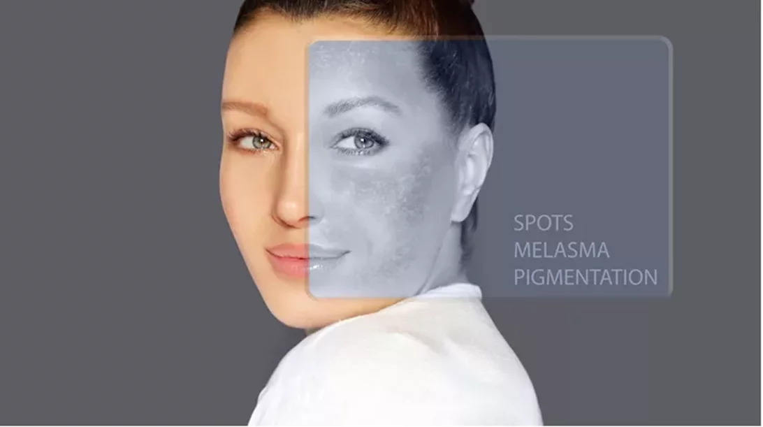 Ποιος φοβάται τις κηλίδες; Όχι εγώ!