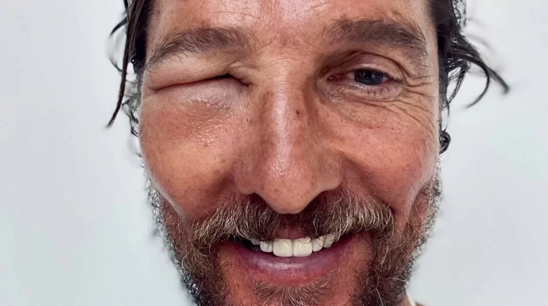 Τι να κάνεις έαν σε τσιμπήσει μέλισσα στο μάτι όπως τον Μάθιου Μακ Κόναχι