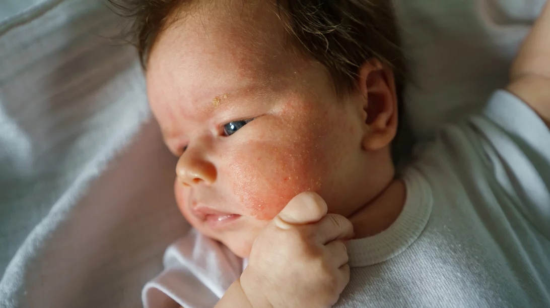 Ατοπική δερματίτιδα: Ποιοι κίνδυνοι απειλούν τα παιδιά