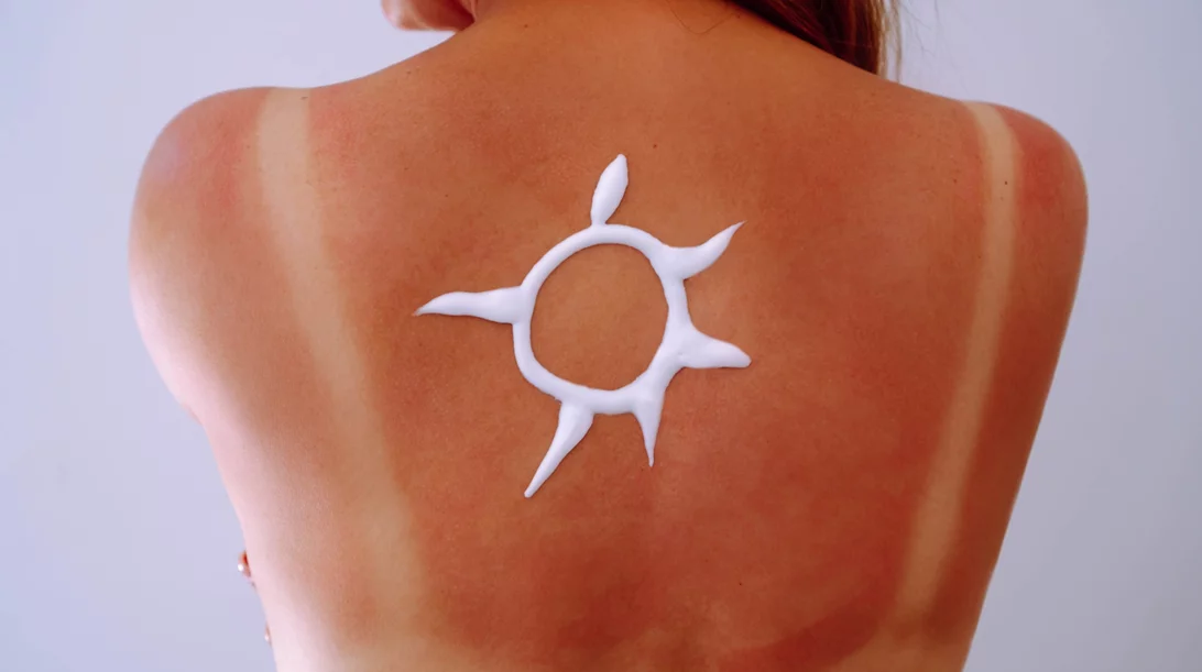 Πώς να θεραπεύσεις γρήγορα το ηλιακό έγκαυμα | Οδηγίες από δερματολόγο