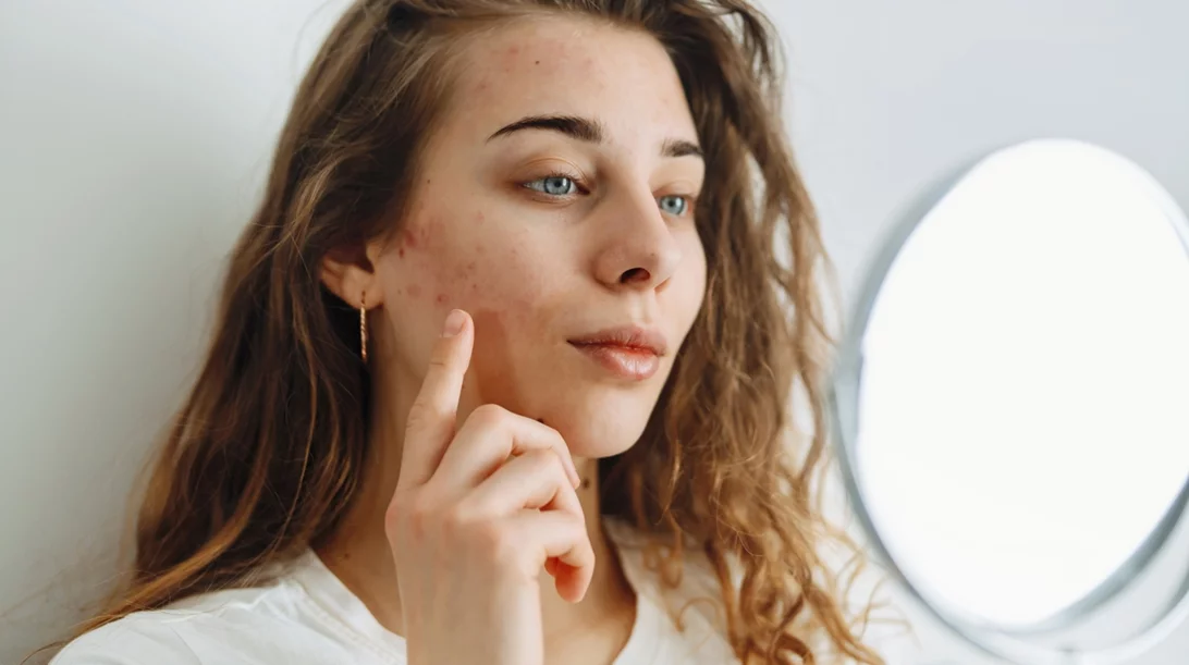 Ακμή: Δερματολόγος προειδοποιεί για τις επικίνδυνες συνέπειες του πιο viral hack της στιγμής!