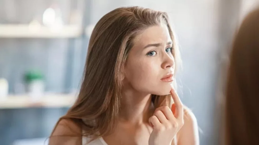 Ακμή στο πηγούνι: Σε τι οφείλεται και πώς μπορείς να την αντιμετωπίσεις