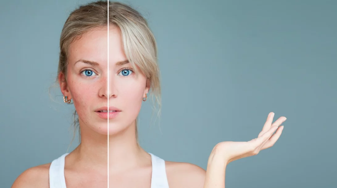 Τι είναι η ροδόχρους νόσος από την οποία πάσχει η Μαίρη Συνατσάκη;