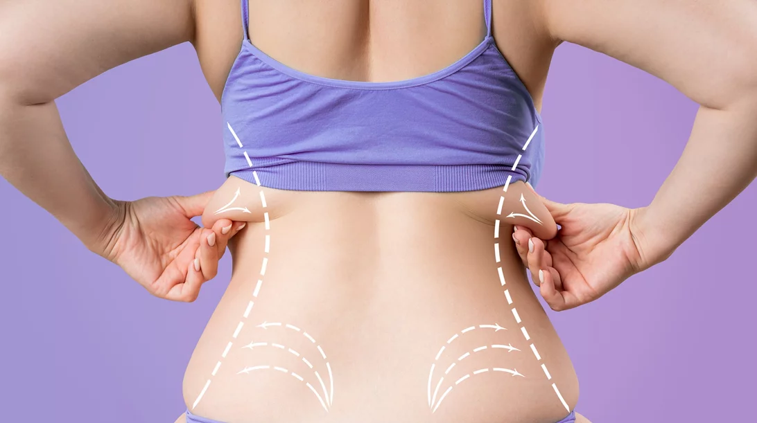 Λιποκύτταρα: Οι επιστήμονες βρήκαν πώς θα τα συρικνώσουν!