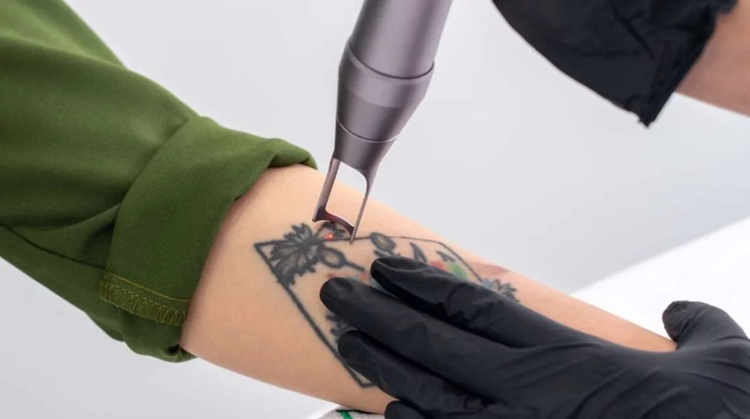 Όλα όσα πρέπει να γνωρίζεις προτού αφαιρέσεις ένα τατουάζ