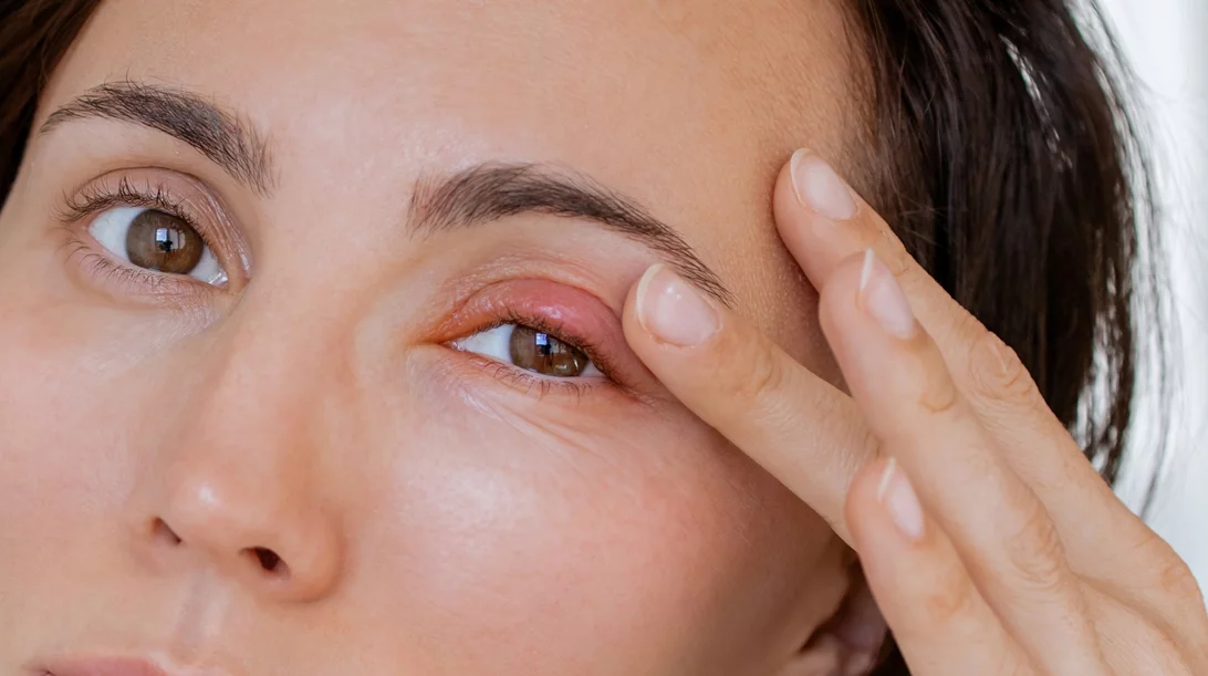 Χαλάζιο: Πώς να απαλλαγείς σύμφωνα με το Stanford Medicine