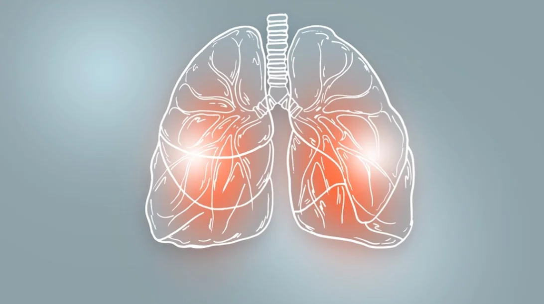 Κυστική ίνωση: Σημαντικά νέα για καινοτόμες θεραπείες