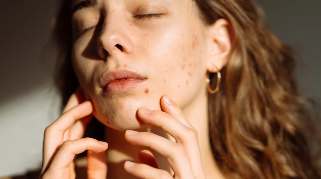 Προβιοτικά: Μπορούν να σε βοηθήσουν να "ξεφορτωθείς" την ακμή;