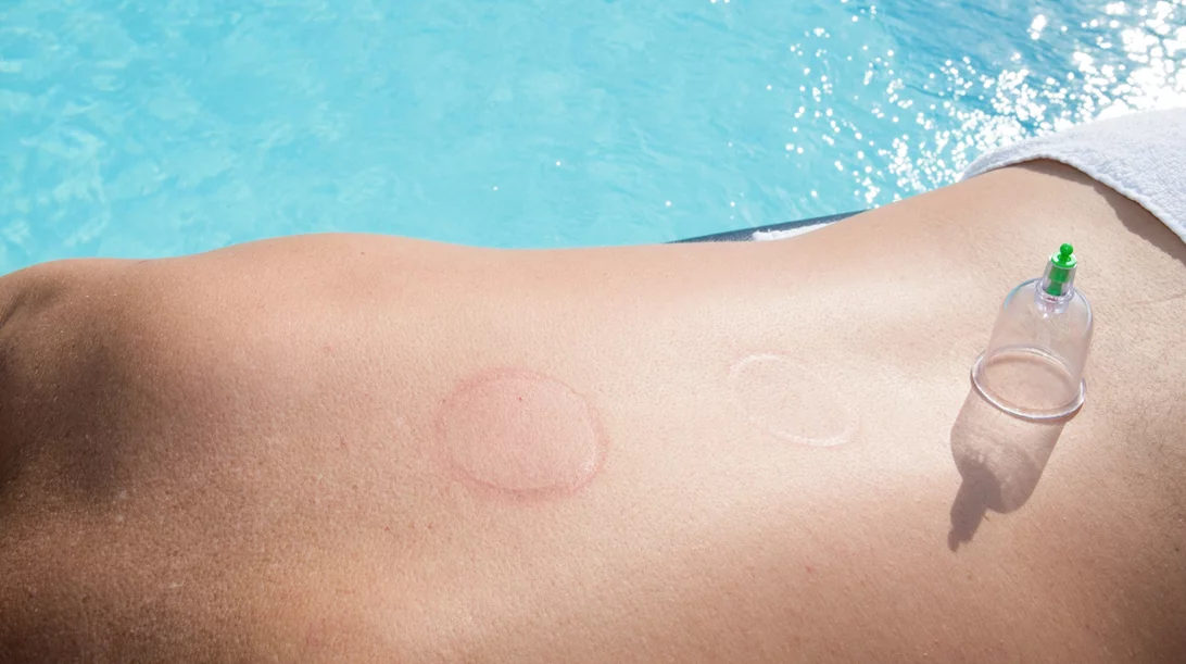 Ολυμπιακοί αγώνες 2024 | Οι βεντούζες τελικά μειώνουν τον πόνο;