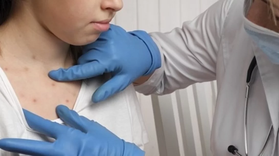 Έκρηξη των κρουσμάτων ιλαράς και στην Ελλάδα: Πώς μεταδίδεται και ποιες ηλικίες θέλουν προσοχή