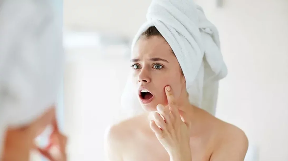 Ακμή; 5 tips για να ξεκινήσεις να την αντιμετωπίζεις από σήμερα κιόλας