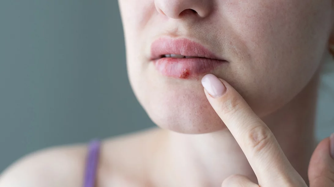Επιχείλιος έρπης ή άφθες; Πώς θα τα ξεχωρίσεις