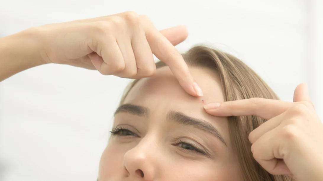 Ακμή ενηλίκων: Πώς αντιμετωπίζεται η ακμή στα 30; Ιδού!