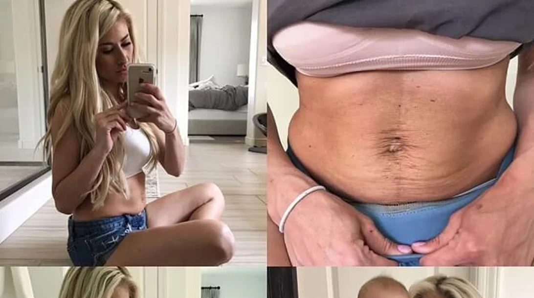 Πώς είναι η κοιλιά μιας γυμνάστριας μετά από δύο εγκυμοσύνες και γέννες