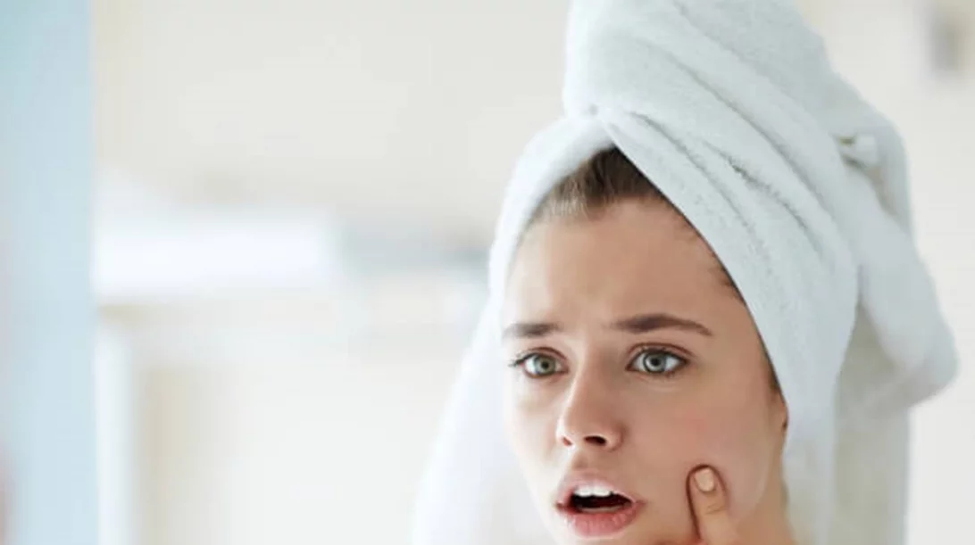 Η ιδανική beauty ρουτίνα για τη θεραπεία της ακμής