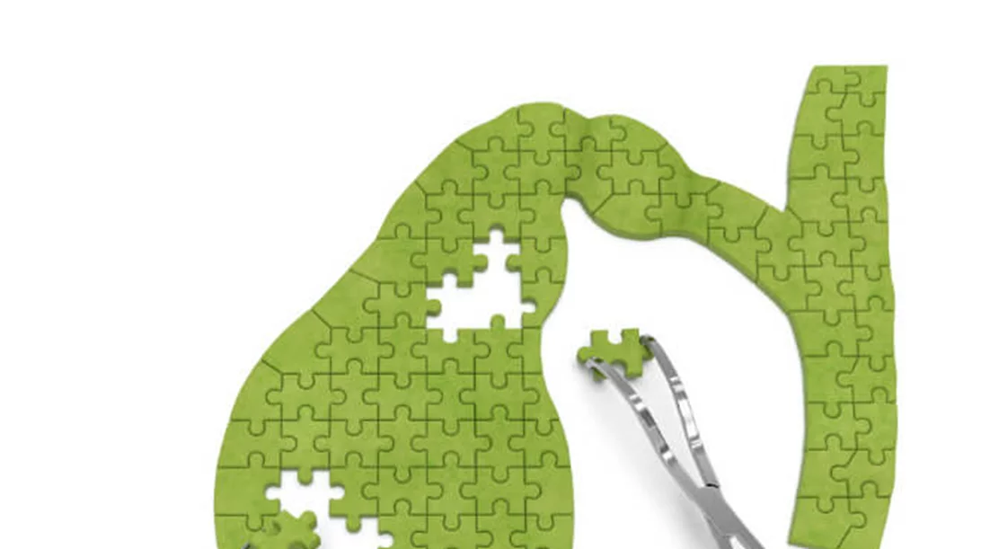 Πέτρες στη χολή: Πρέπει να τις αφαιρούμε ακόμη κι αν δεν έχουμε ενοχλήσεις;