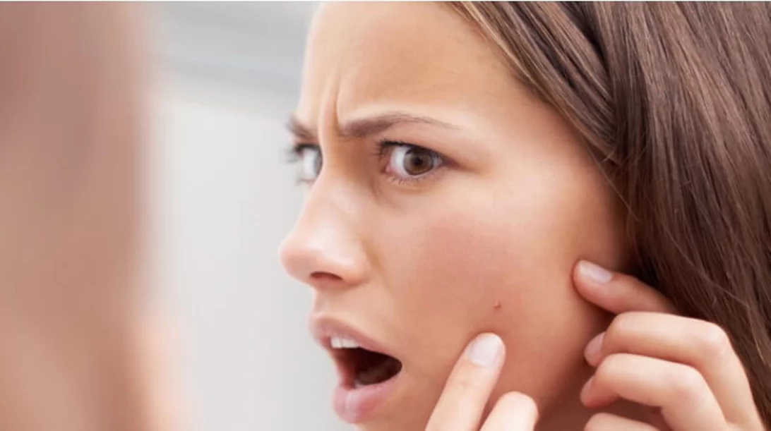 Μπορείς να σπάσεις σωστά ένα σπυράκι στο πρόσωπο;