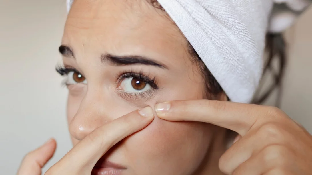 Κυστική ακμή: Ο πιο γρήγορος τρόπος να απαλλαγείς από τα επώδυνα σπυράκια