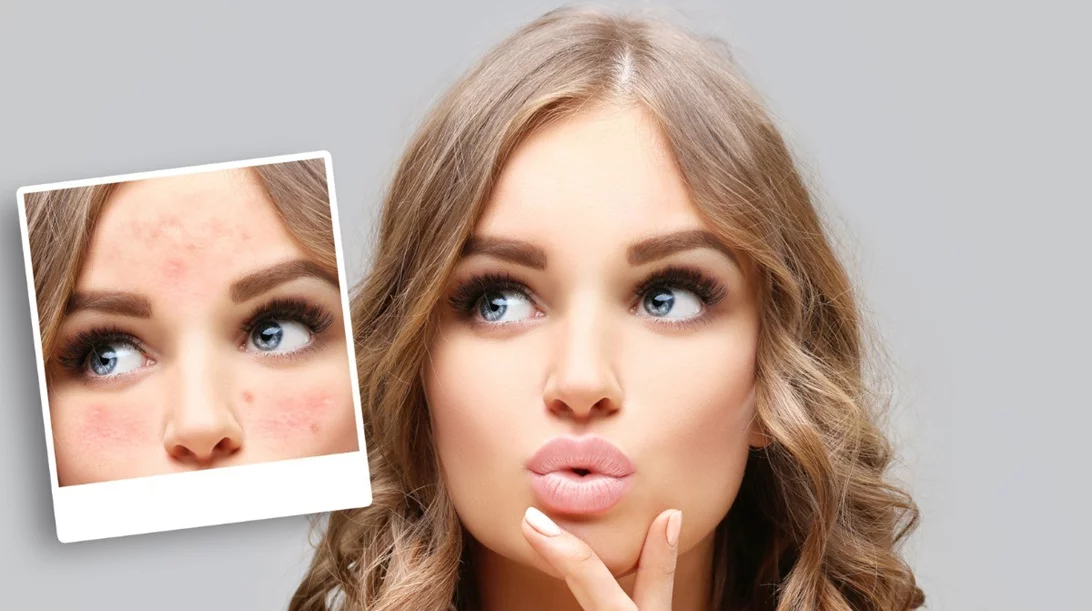 Τι είναι η ροδόχρους ακμή; 6 facts για τη νόσο από την οποία πάσχει η Σοφία Φαραζή