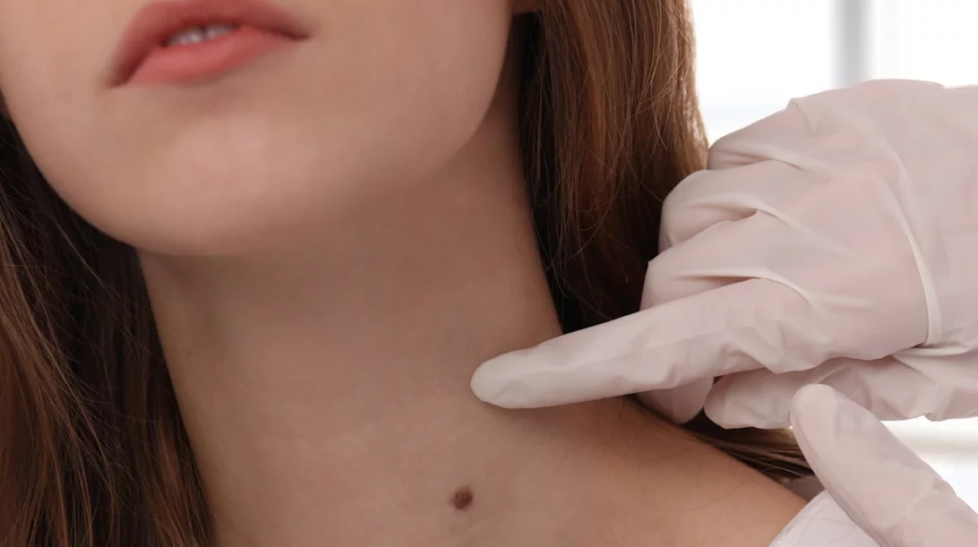 Δερματολογικός έλεγχος: Ποια είναι η καλύτερη εποχή;