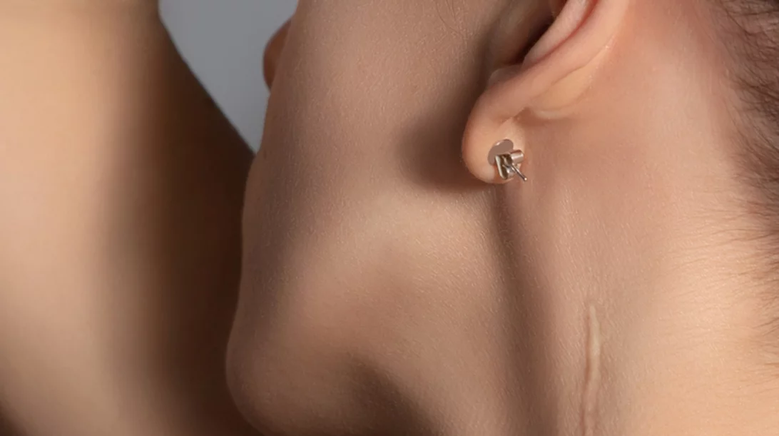 Η βιταμίνη Ε μειώνει τις ουλές;