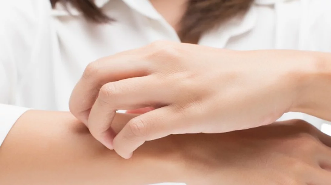 Έκζεμα στα χέρια: Ξεκινά η πρώτη κλινική μελέτη φάσης 3 για τη νόσο