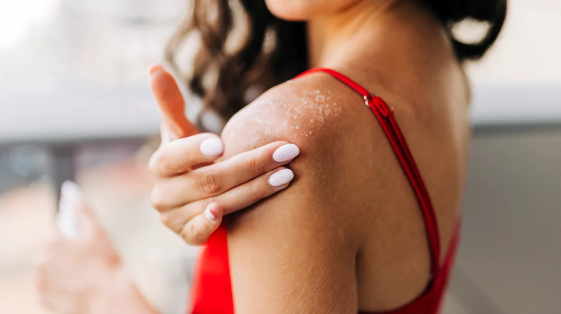 Κάηκες από τον ήλιο και ξεφλούδισες; Τι ΔΕΝ πρέπει να κάνεις;