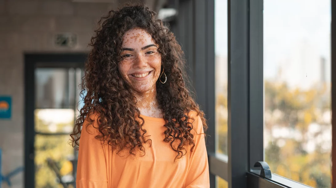 Λεύκη: Οι θεραπείες και το "κλειδί" για το σπάνιο αυτοάνοσο