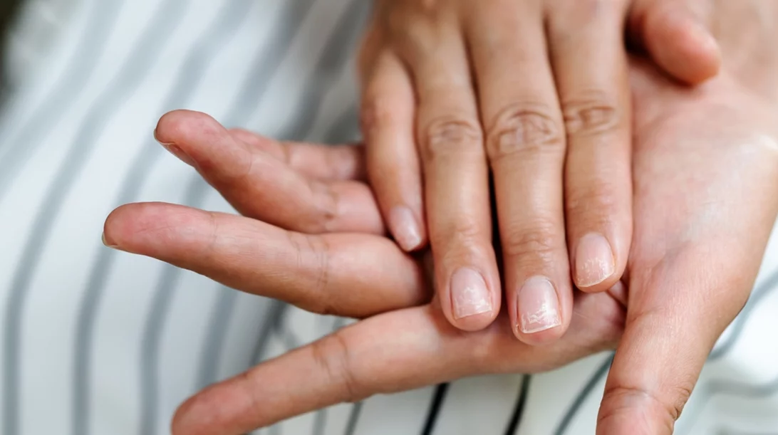 Η ανεπαίσθητη αλλαγή στο νύχι μίας 38χρονης που άλλαξε τα πάντα - Ο καρκίνος που κανείς δεν προέβλεψε