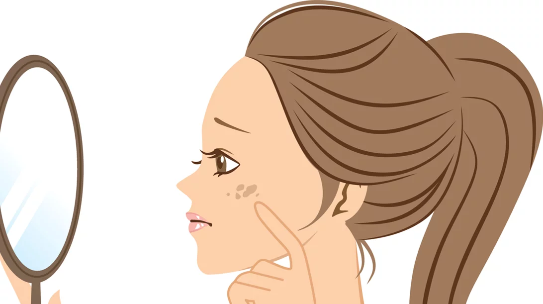 Υπερμελάγχρωση: Τα SOS της αντιμετώπισης των καφέ κηλίδων στο δέρμα