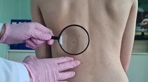 Ελιές στο δέρμα: Τι είναι η χαρτογράφηση σπίλων;