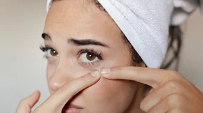 Ποια είναι η θεραπεία για την ακμή; Η δερματολόγος απαντά