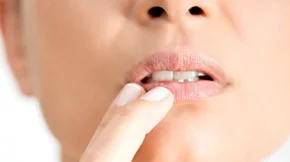 Επιχείλιος έρπης: Τα αίτια, η θεραπεία και η αντιμετώπιση του ιού