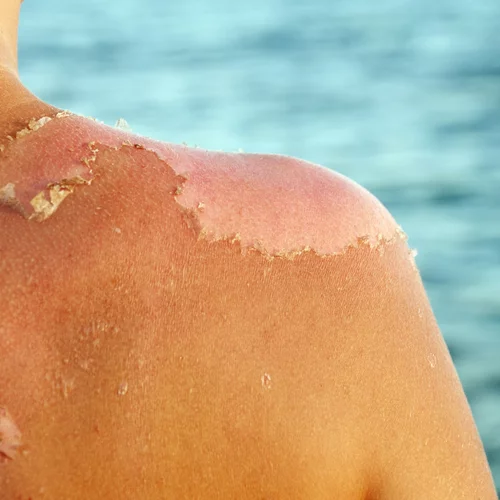 Κάηκες; Ανακούφισε το δέρμα σου με 5 σπιτικά γιατροσόφια