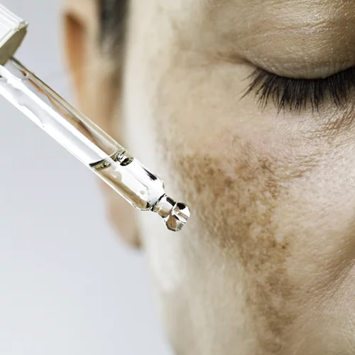 Σκούρες κηλίδες στο πρόσωπο: Οι 5 καλύτεροι οροί για την εξάλειψή τους