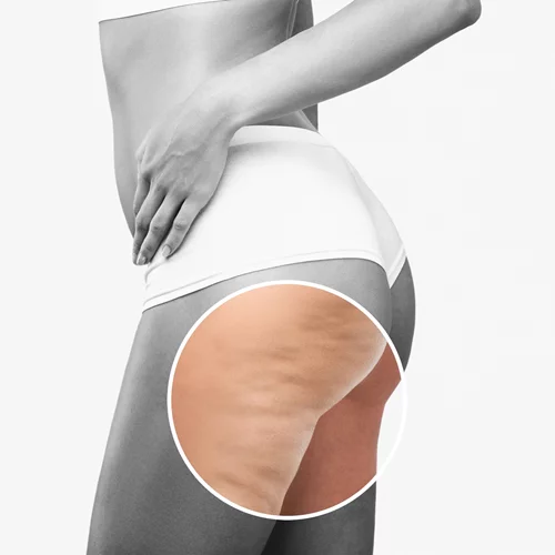 5 λάδια σώματος για να πεις "αντίο" στην κυτταρίτιδα λίγο πριν τις διακοπές