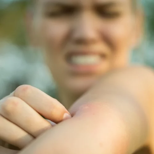 Τσιμπήματα κουνουπιών: Τι είναι αυτό που έλκει τα κουνούπια πάνω μας;