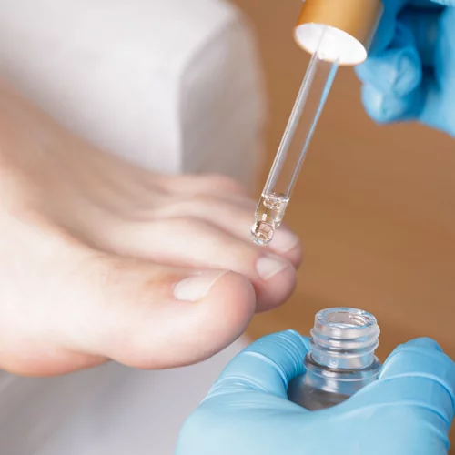 Είσφρυση όνυχος: Πώς το θεραπεύσεις αποτελεσματικά