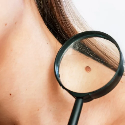 Εμβόλιο για τον καρκίνο του δέρματος: Τι περιμένουμε και πώς θα δρα