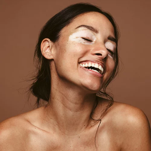 Τι είναι η λεύκη; Η θεραπεία και συμβουλές για το καλοκαίρι