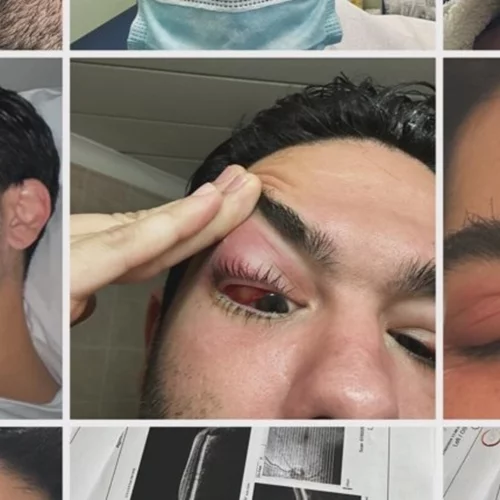 Πόσο σπάνια είναι η δακρυοαδενίτιδα από την οποία πάσχει ο Χρήστος Μάστορας;