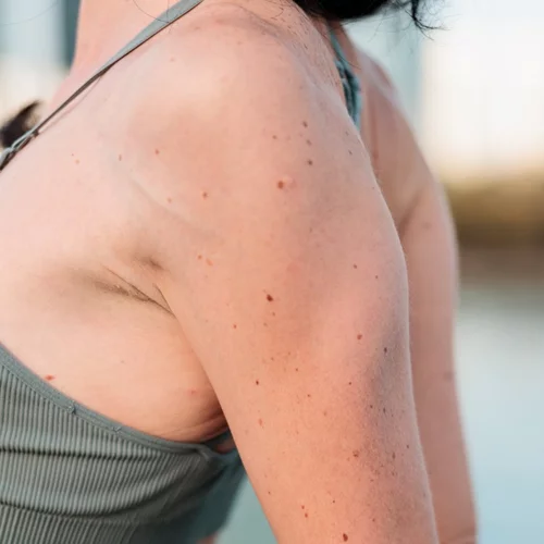 Πόνος στον ώμο: Ο ορθοπαιδικός εξηγεί τι είναι η τενοντίδα ώμου